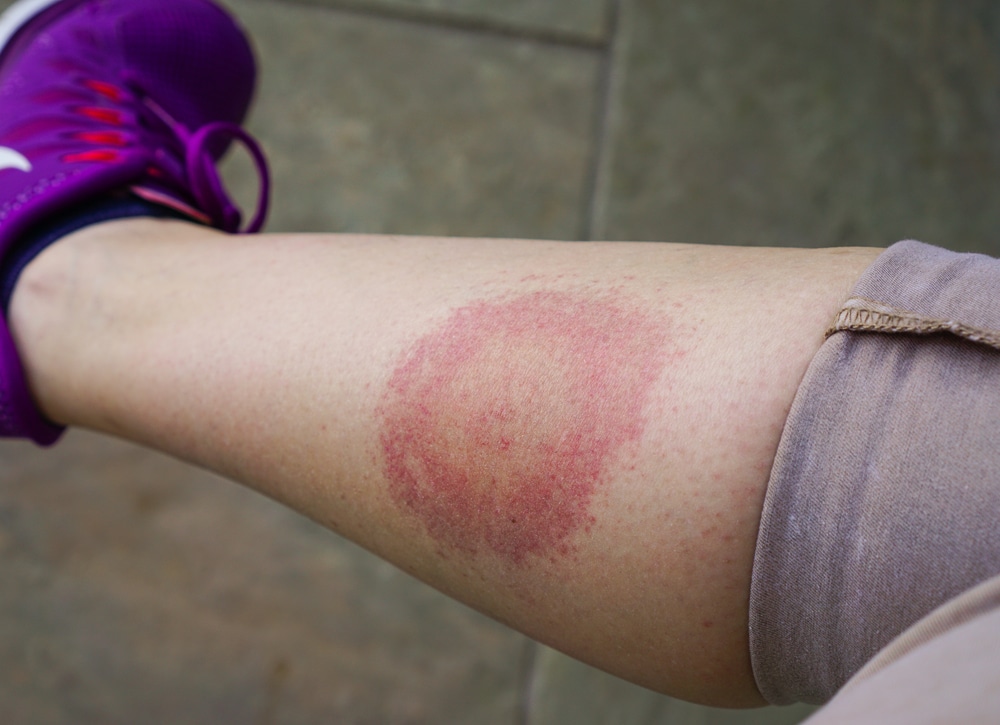 What Is Lyme Disease: A Deep Dive Into the Disease | Knox Wellness
